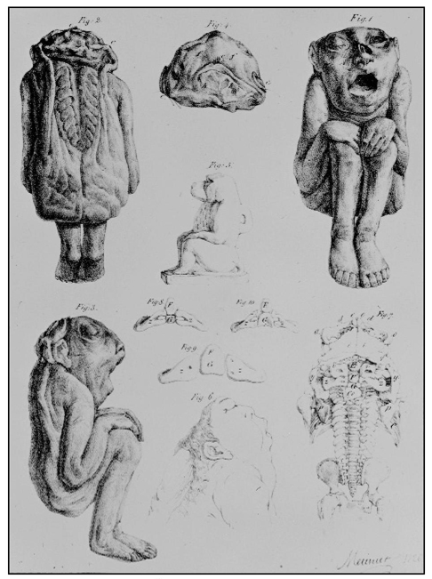 anencephalic saint-hilaire