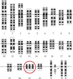 Down's syndrome karyotype