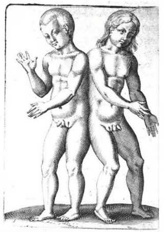 hermaphroditic conjoined twins