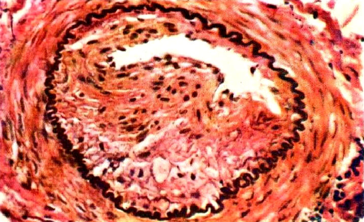 atherosclerosis in a pig