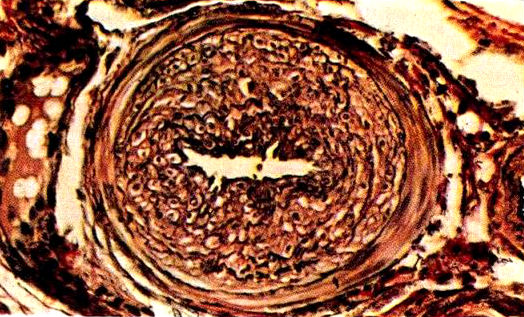 atherosclerosis in a pig